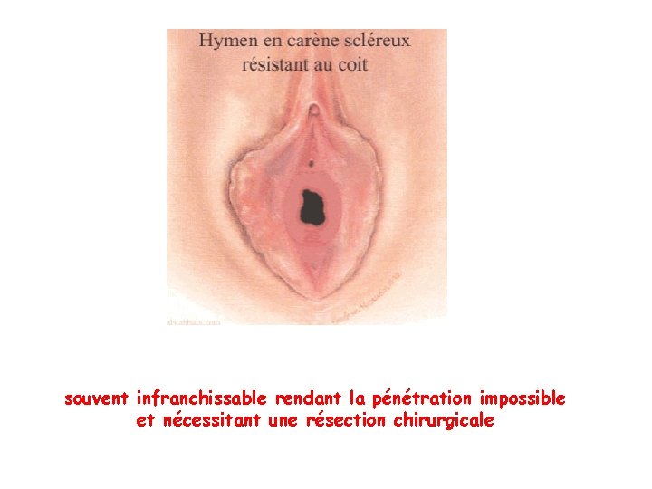 souvent infranchissable rendant la pénétration impossible et nécessitant une résection chirurgicale souvent infranchissable rendant la pénétration impossible et nécessitant une résection chirurgicale