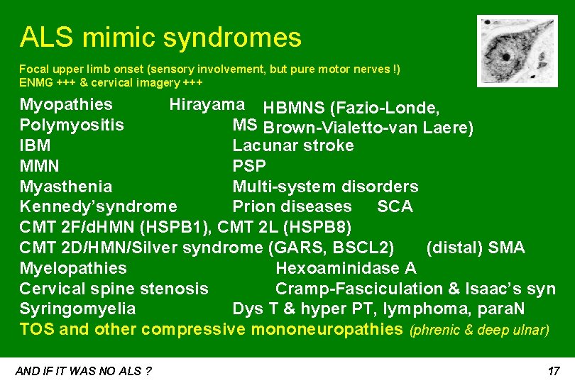 ALS mimic syndromes Focal upper limb onset (sensory involvement, but pure motor nerves !)