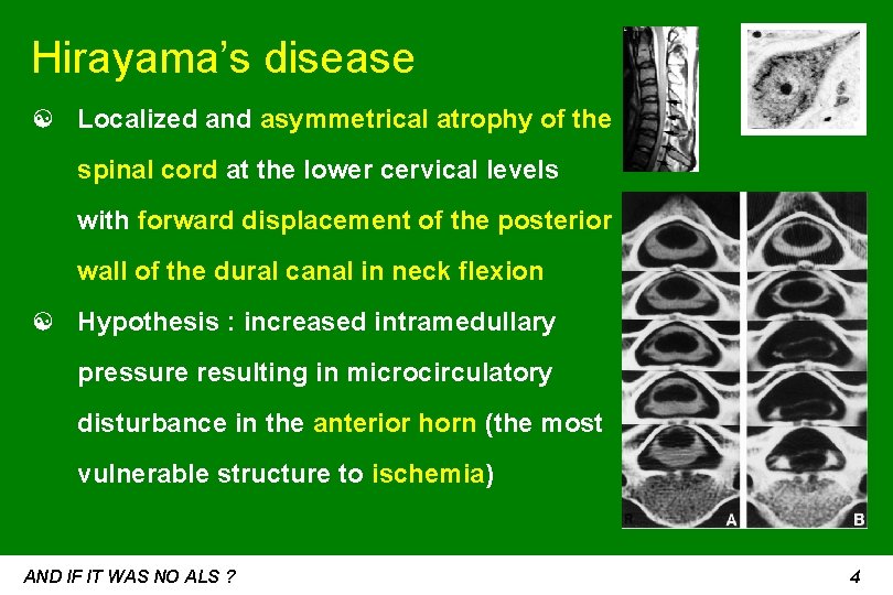Hirayama’s disease ☯ Localized and asymmetrical atrophy of the spinal cord at the lower