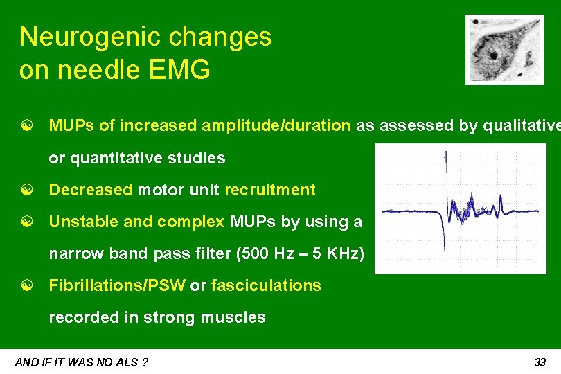 Neurogenic changes on needle EMG ☯ MUPs of increased amplitude/duration as assessed by qualitative