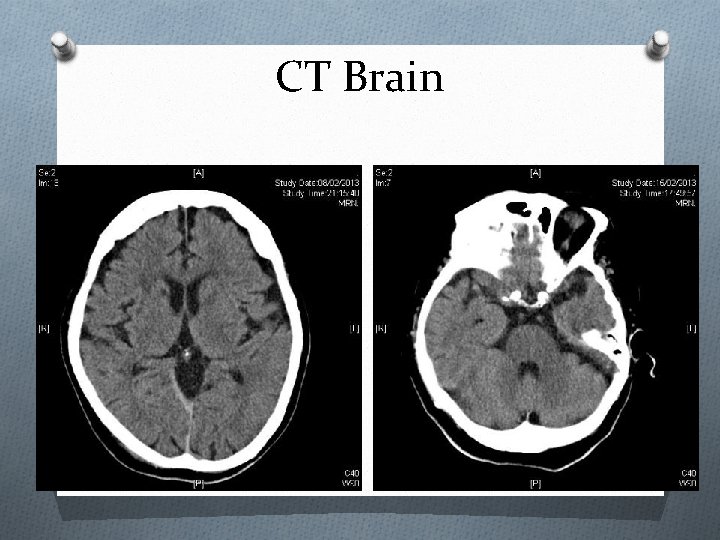 CT Brain 