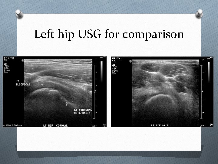 Left hip USG for comparison 
