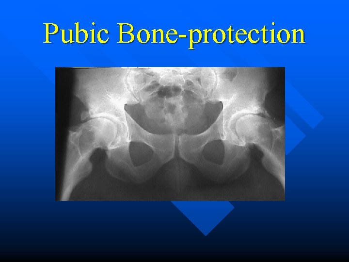 Pubic Bone-protection 