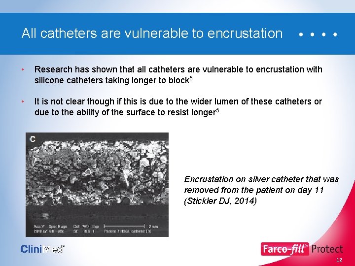 All catheters are vulnerable to encrustation • Research has shown that all catheters are