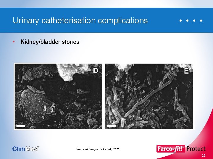 Urinary catheterisation complications • Kidney/bladder stones Source of images: Li X et al, 2002