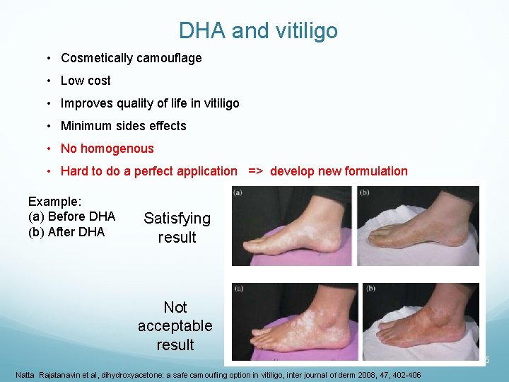 DHA and vitiligo • Cosmetically camouflage • Low cost • Improves quality of life