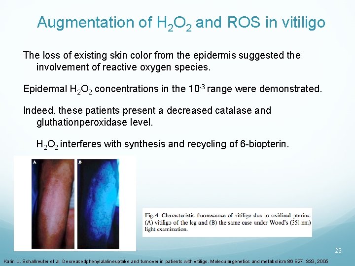 Augmentation of H 2 O 2 and ROS in vitiligo The loss of existing