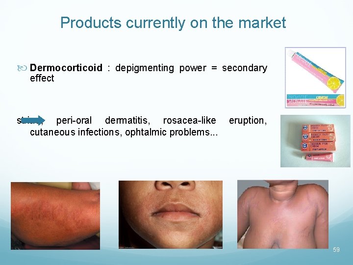 Products currently on the market Dermocorticoid : depigmenting power = secondary effect striae, peri-oral