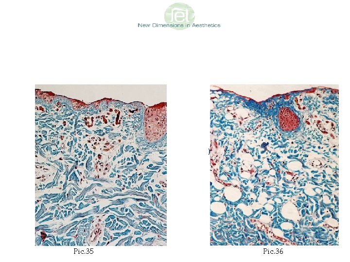 Researches: Dermabrasion versus Jet. Peel Dermabrasion Loss of epidermal layer Jet. Peel Vacuolization (O