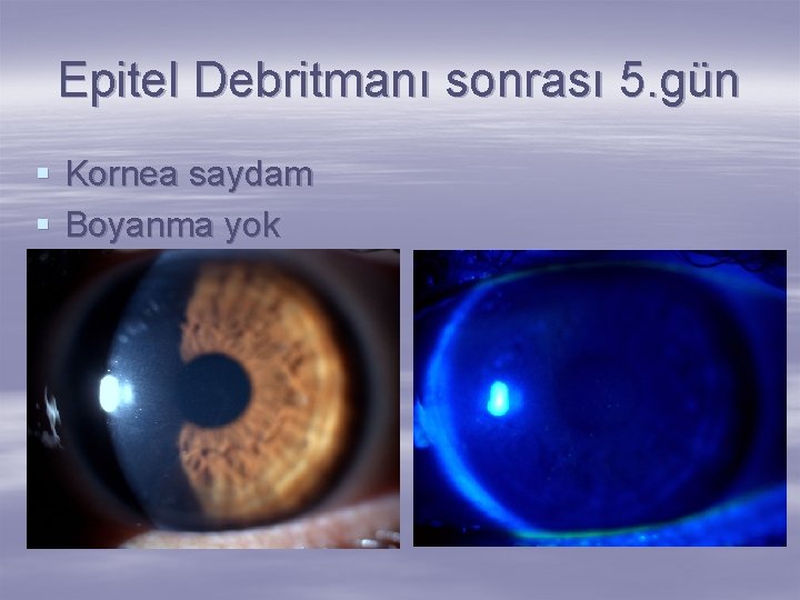 Epitel Debritmanı sonrası 5. gün § Kornea saydam § Boyanma yok 