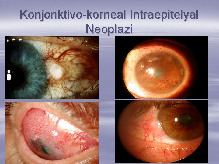 Konjonktivo-korneal Intraepitelyal Neoplazi 