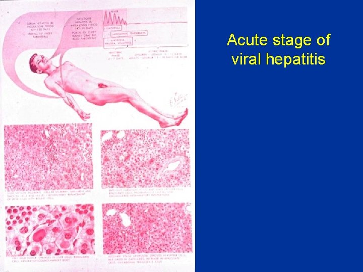 Acute stage of viral hepatitis 