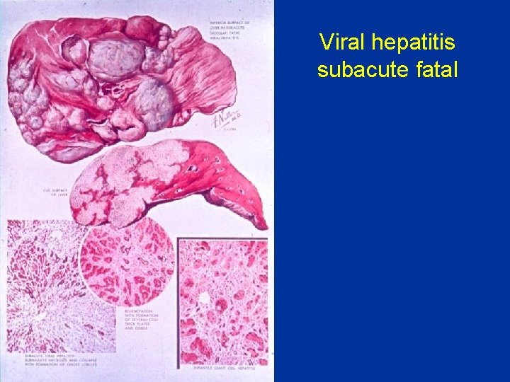 Viral hepatitis subacute fatal 
