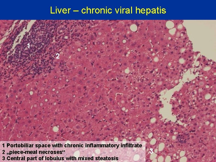 Liver – chronic viral hepatis 1 2 1 Portobiliar space with chronic inflammatory infiltrate