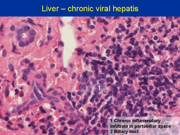 Liver – chronic viral hepatis 2 1 1 Chronic inflammatory infiltrate in portobiliar space