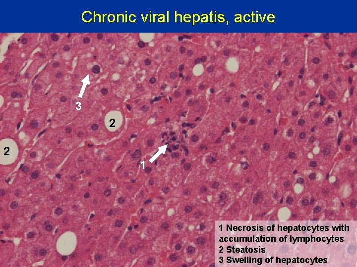Chronic viral hepatis, active 3 2 2 1 1 Necrosis of hepatocytes with accumulation
