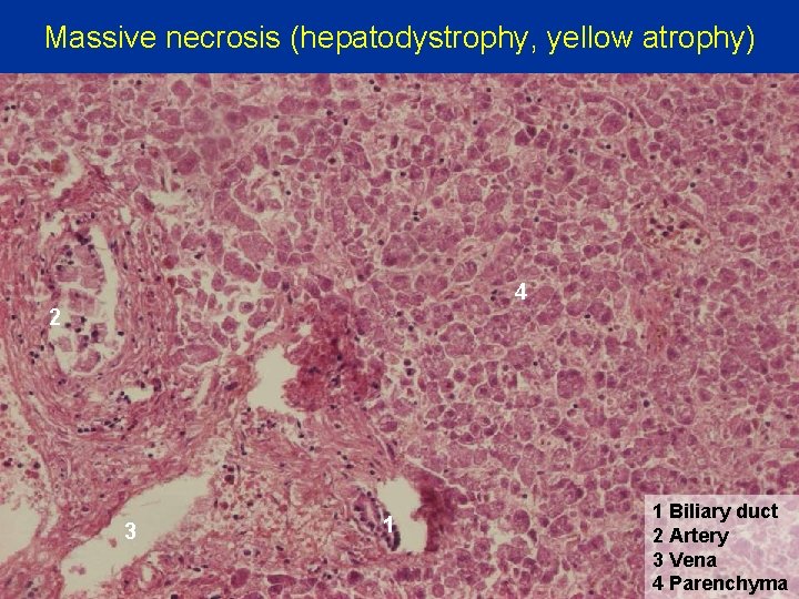 Massive necrosis (hepatodystrophy, yellow atrophy) 4 2 3 1 1 Biliary duct 2 Artery