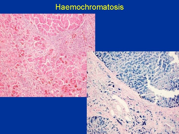 Haemochromatosis 