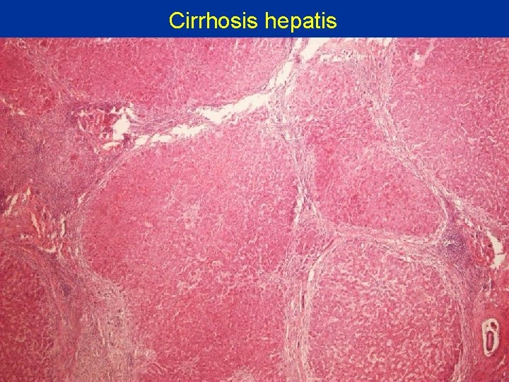 Cirrhosis hepatis 