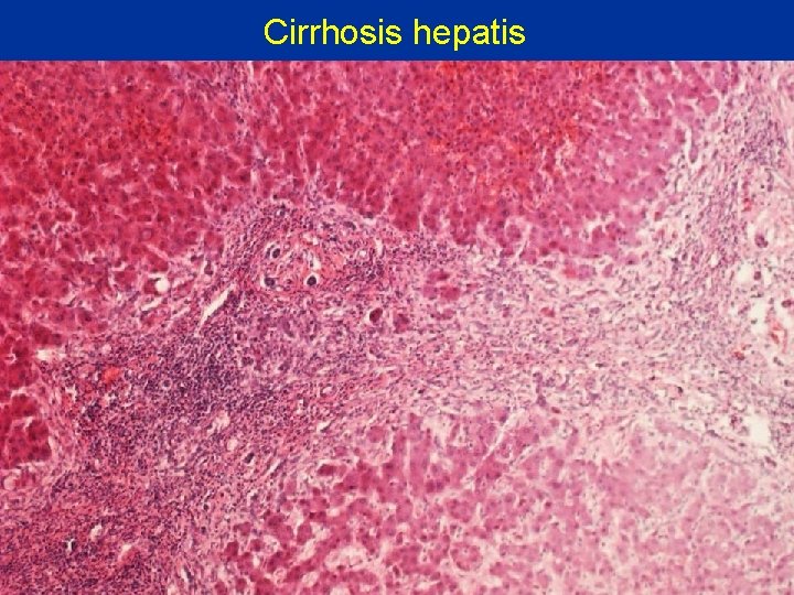 Cirrhosis hepatis 