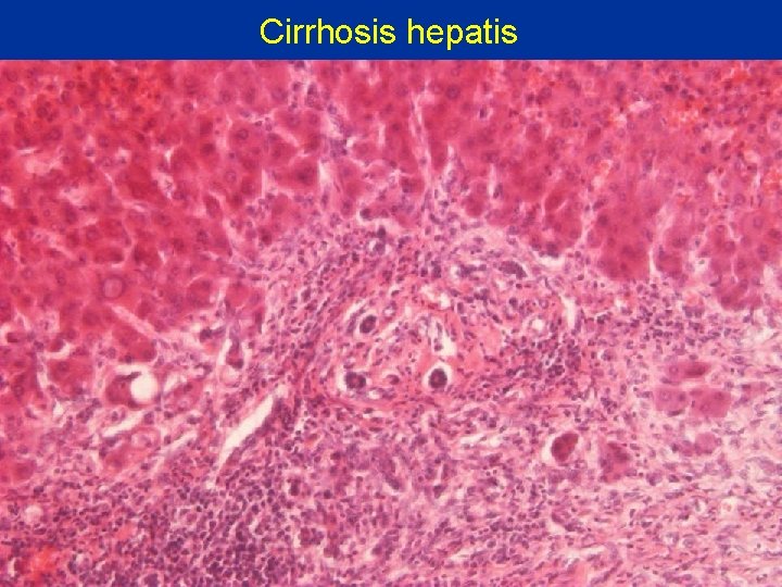 Cirrhosis hepatis 