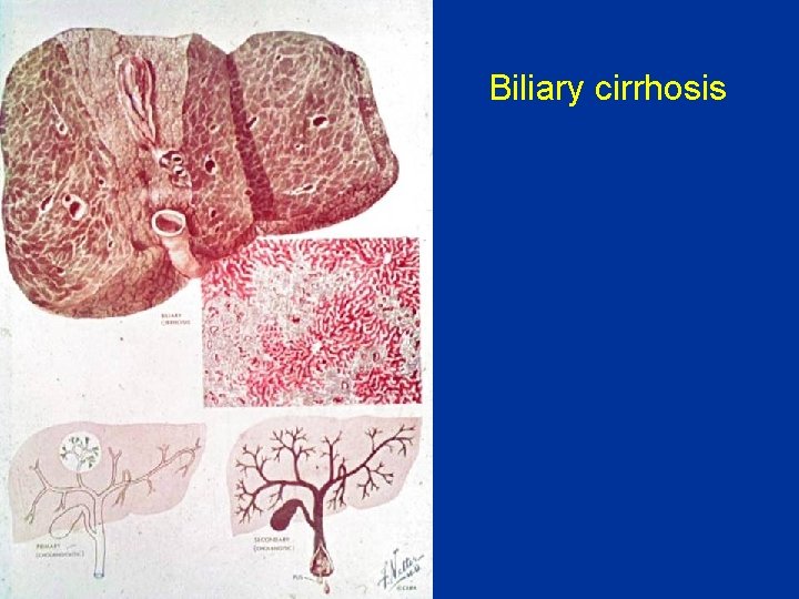 Biliary cirrhosis 