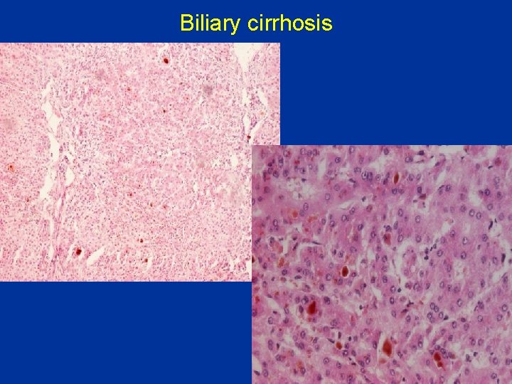 Biliary cirrhosis 