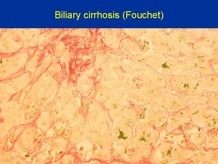 Biliary cirrhosis (Fouchet) 