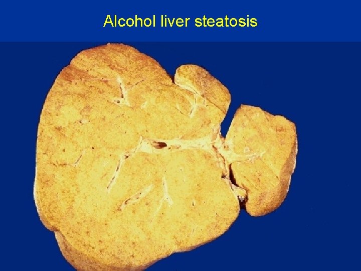 Alcohol liver steatosis 