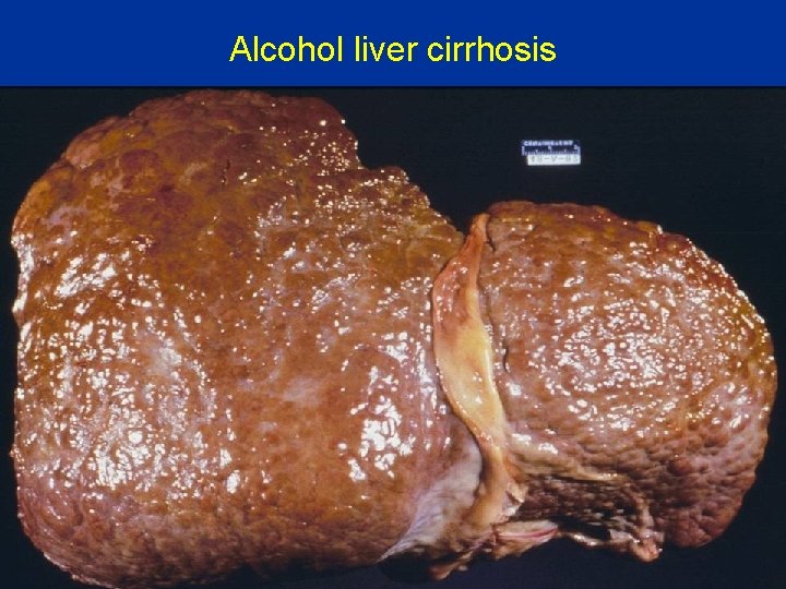 Alcohol liver cirrhosis 
