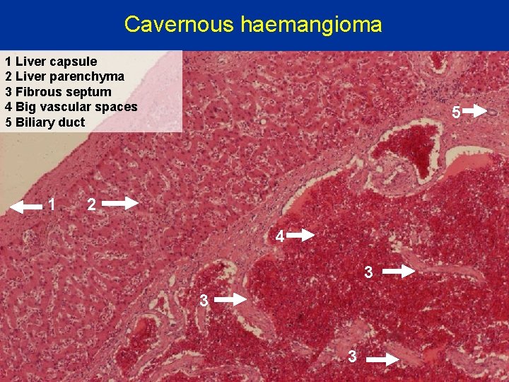 Cavernous haemangioma 1 Liver capsule 2 Liver parenchyma 3 Fibrous septum 4 Big vascular