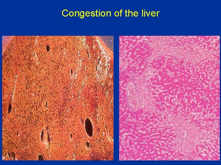 Congestion of the liver 