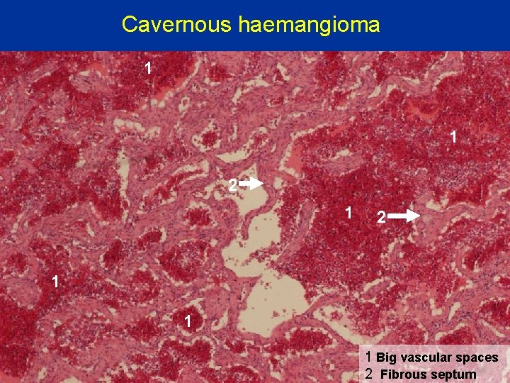 Cavernous haemangioma 1 1 2 1 1 1 Big vascular spaces 2 Fibrous septum