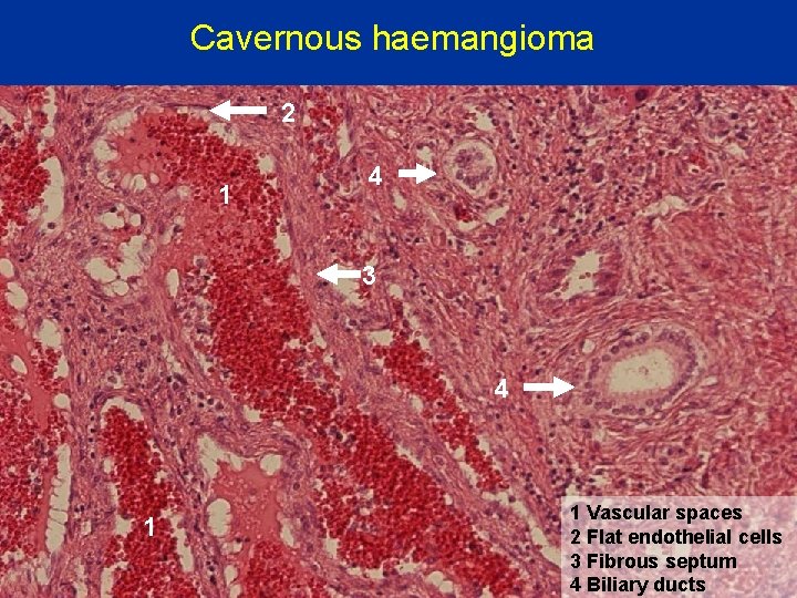 Cavernous haemangioma 2 1 4 3 4 1 1 Vascular spaces 2 Flat endothelial
