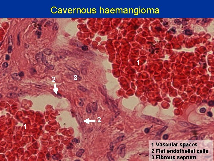 Cavernous haemangioma 1 2 1 3 2 1 Vascular spaces 2 Flat endothelial cells