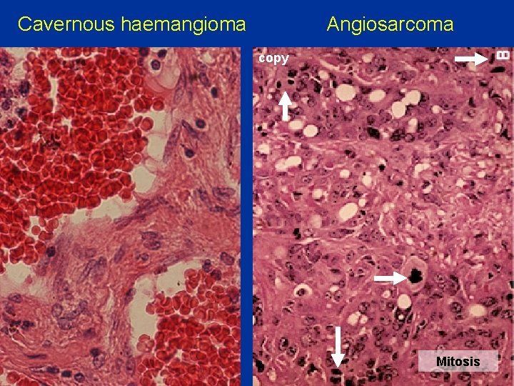 Cavernous haemangioma Angiosarcoma copy Mitosis 