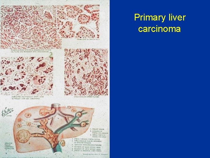 Primary liver carcinoma 