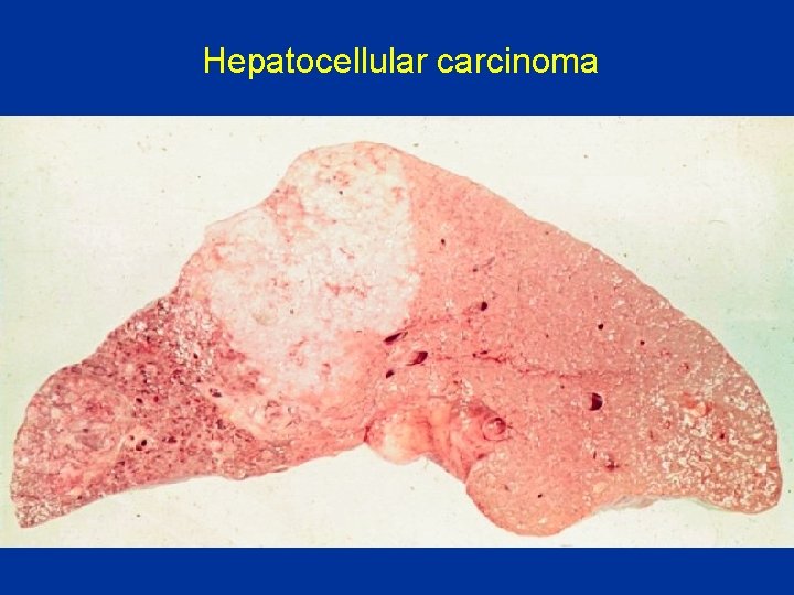 Hepatocellular carcinoma 