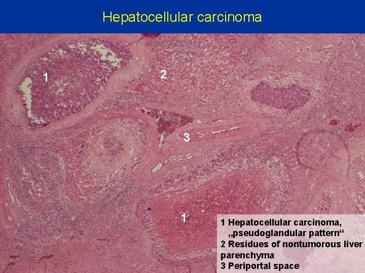 Hepatocellular carcinoma 1 2 3 1 1 Hepatocellular carcinoma, „pseudoglandular pattern“ 2 Residues of