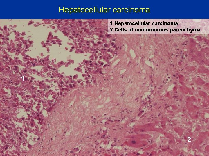 Hepatocellular carcinoma 1 Hepatocellular carcinoma 2 Cells of nontumorous parenchyma 1 2 