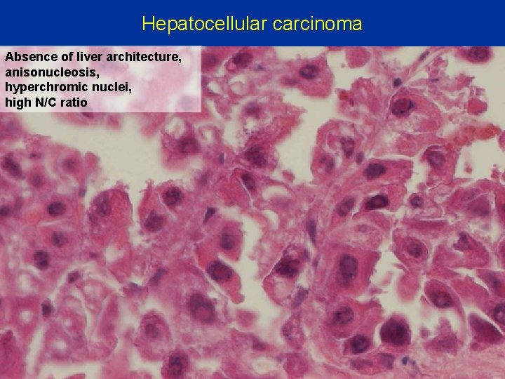 Hepatocellular carcinoma Absence of liver architecture, anisonucleosis, hyperchromic nuclei, high N/C ratio 