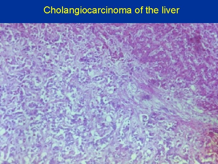Cholangiocarcinoma of the liver 