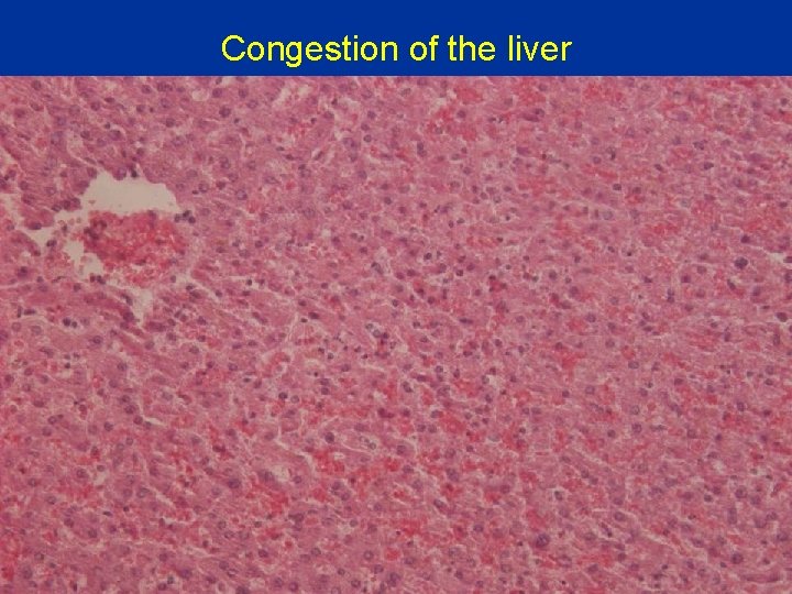 Congestion of the liver 
