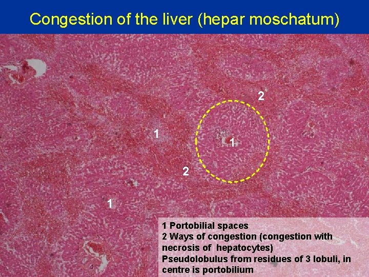 Congestion of the liver (hepar moschatum) 2 1 1 Portobilial spaces 2 Ways of