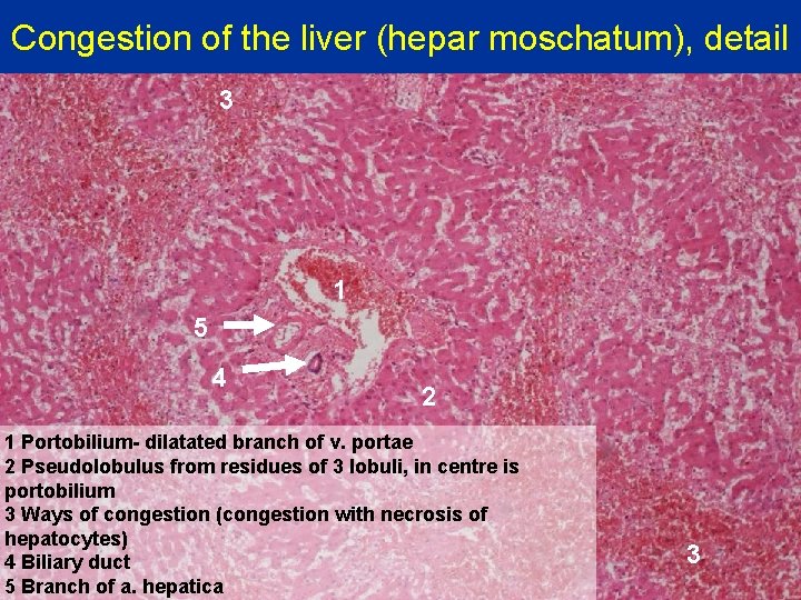 Congestion of the liver (hepar moschatum), detail 3 1 5 4 2 1 Portobilium-