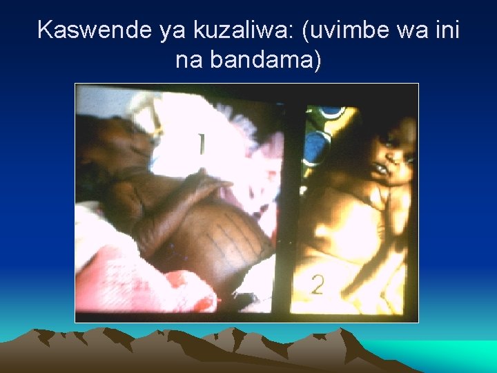 Kaswende ya kuzaliwa: (uvimbe wa ini na bandama) 