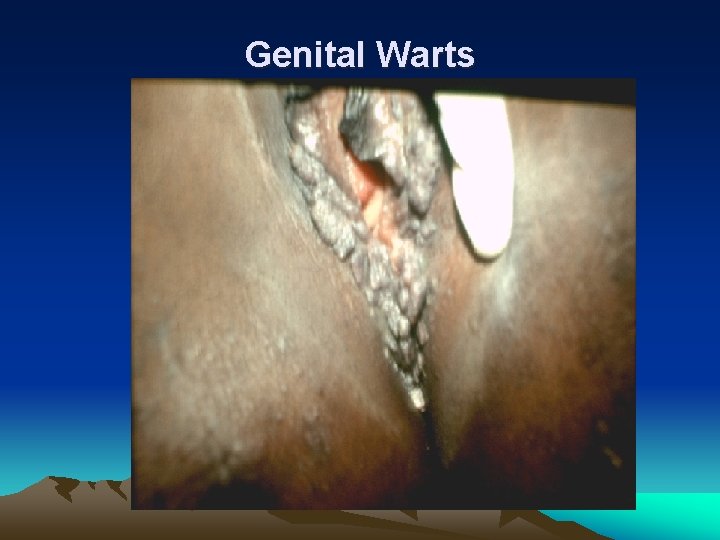 Genital Warts 