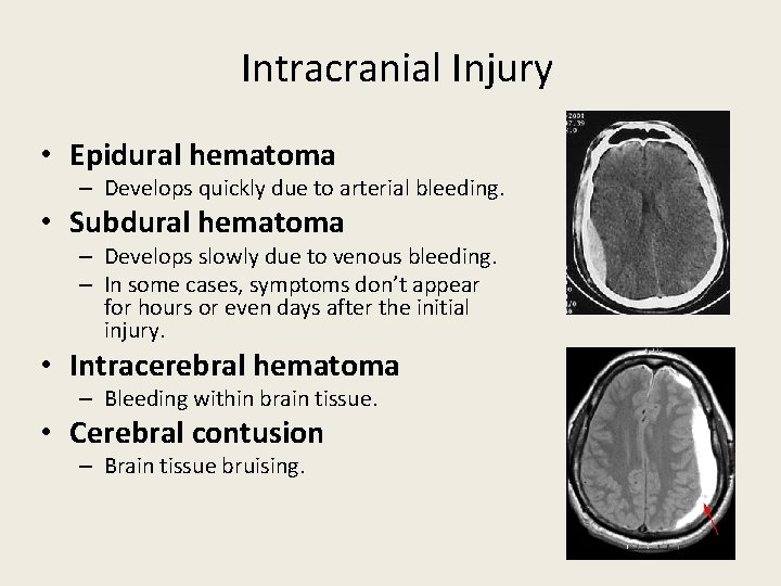 Intracranial Injury • Epidural hematoma – Develops quickly due to arterial bleeding. • Subdural