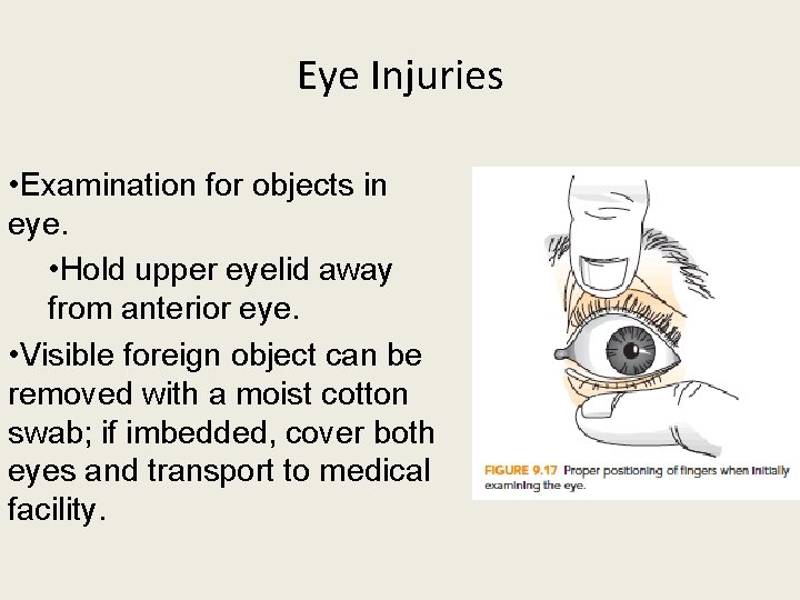 Eye Injuries • Examination for objects in eye. • Hold upper eyelid away from