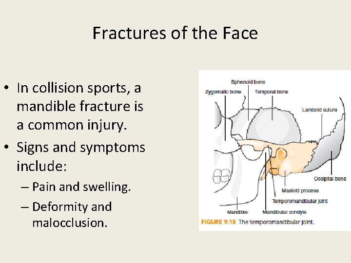 Fractures of the Face • In collision sports, a mandible fracture is a common